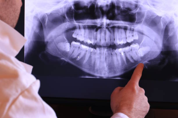 Best Emergency Wisdom Tooth Extraction in Magna, UT
